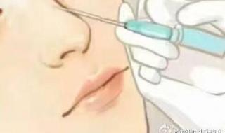 缩小鼻头多少钱 缩小鼻头多少钱